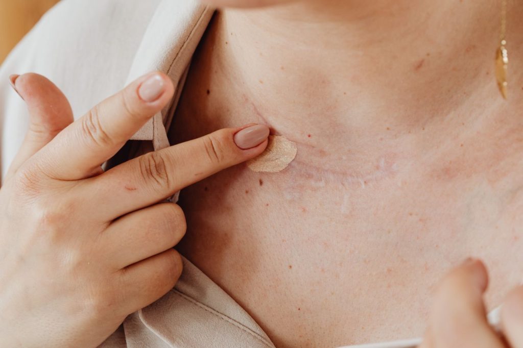 A person applies concealer on a neck scar with manicured nails in a close-up shot.